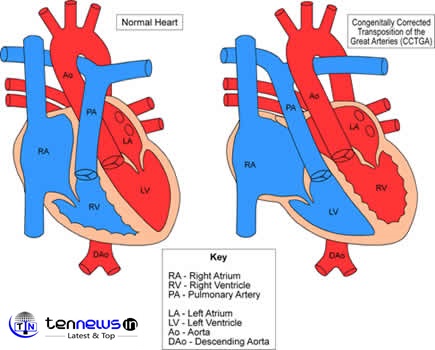Normal vs CGTA Heart